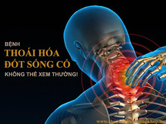 3 Nhóm Có Nguy Cơ Bị Thoái Hóa Cột Sống Cổ Cao